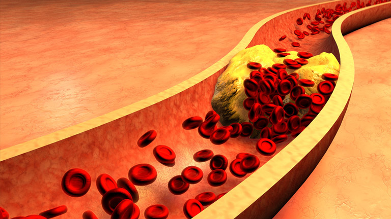 A clogged artery, the cause of high cholesterol